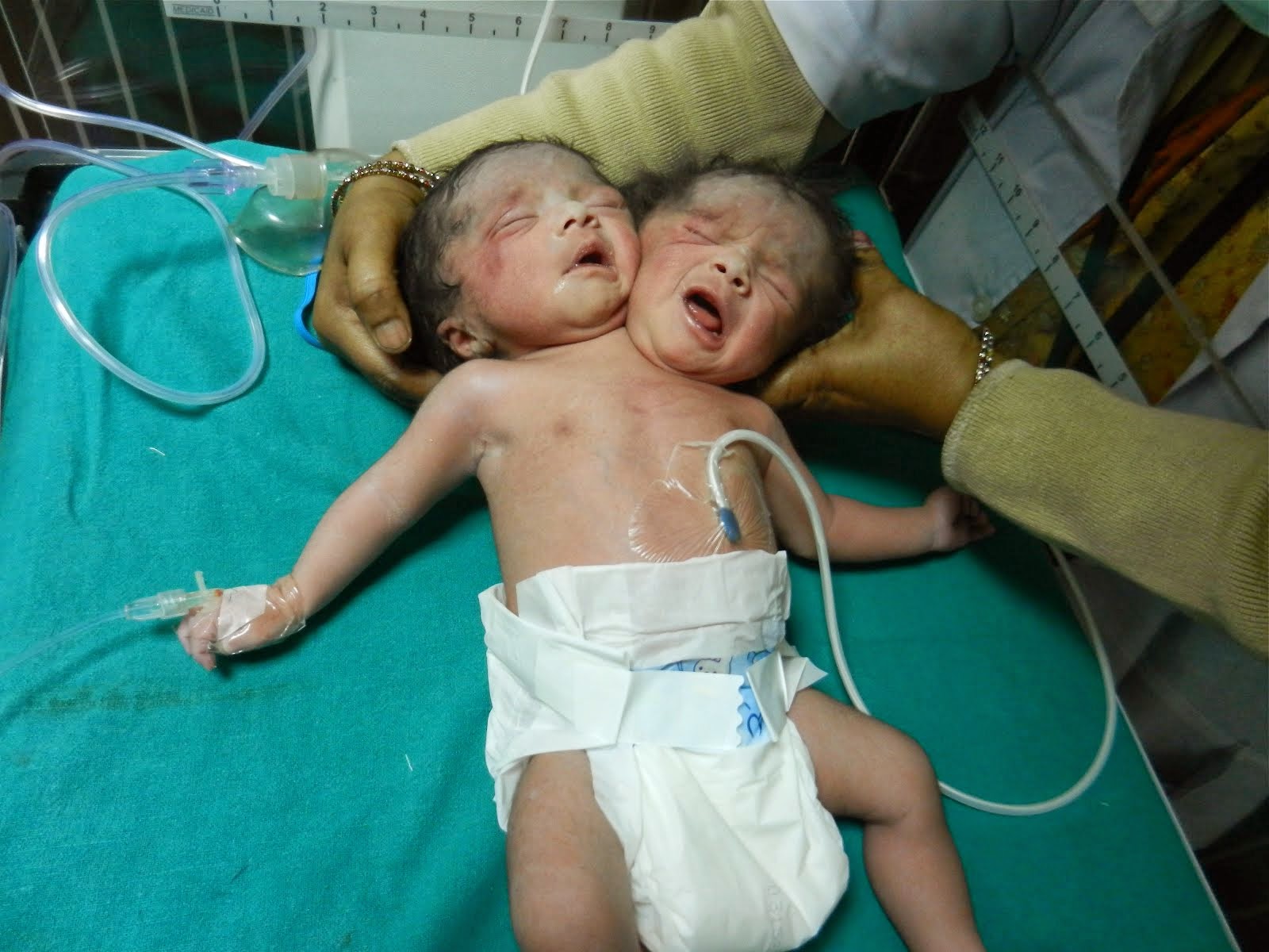 Photo of ‘Female Baby Having Two Heads’ Born In India