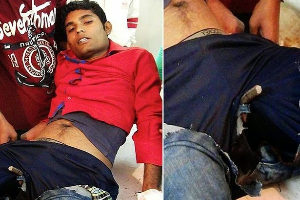 Photo of Red-faced man gets iron rod stuck up his bottom – his excuse is even more bizarre