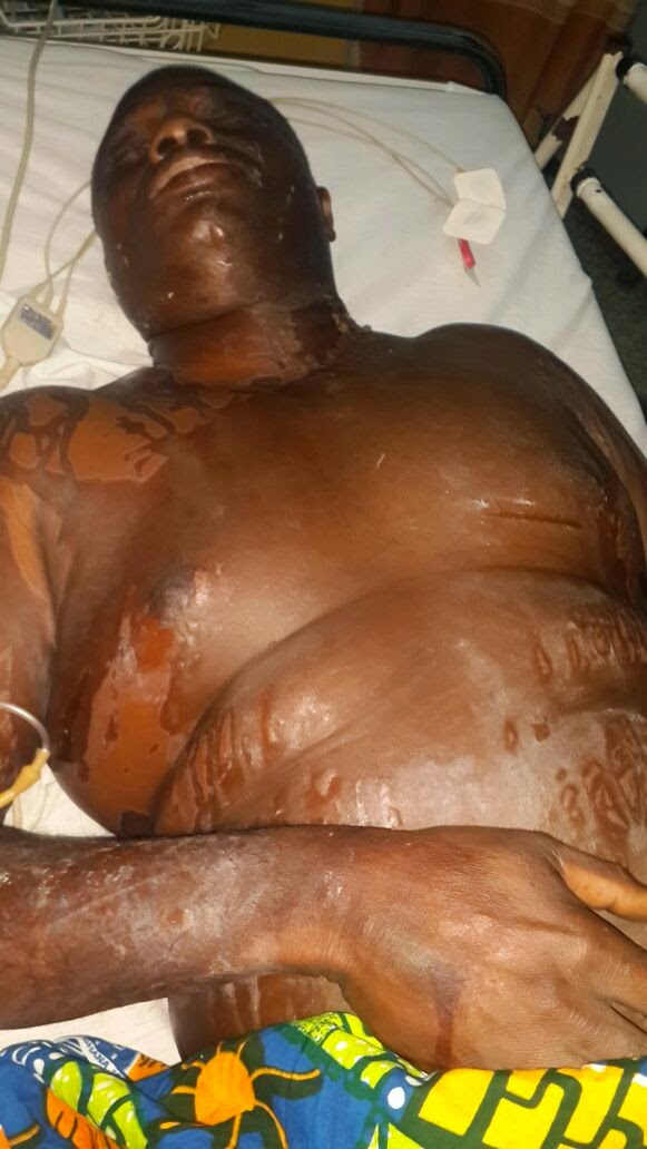 Photo of Upper East NPP chairman dies after acid attack