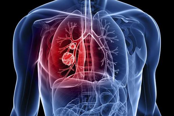 Photo of Air pollution may shorten survival chances in lung cancer patients